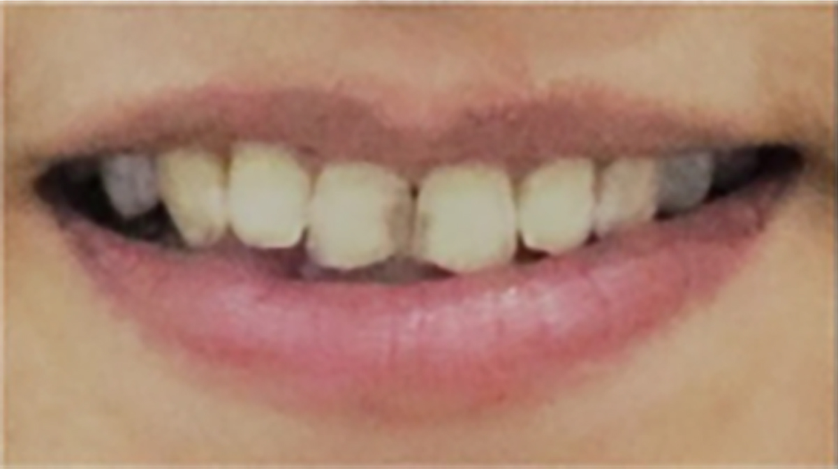 Antes caso 1