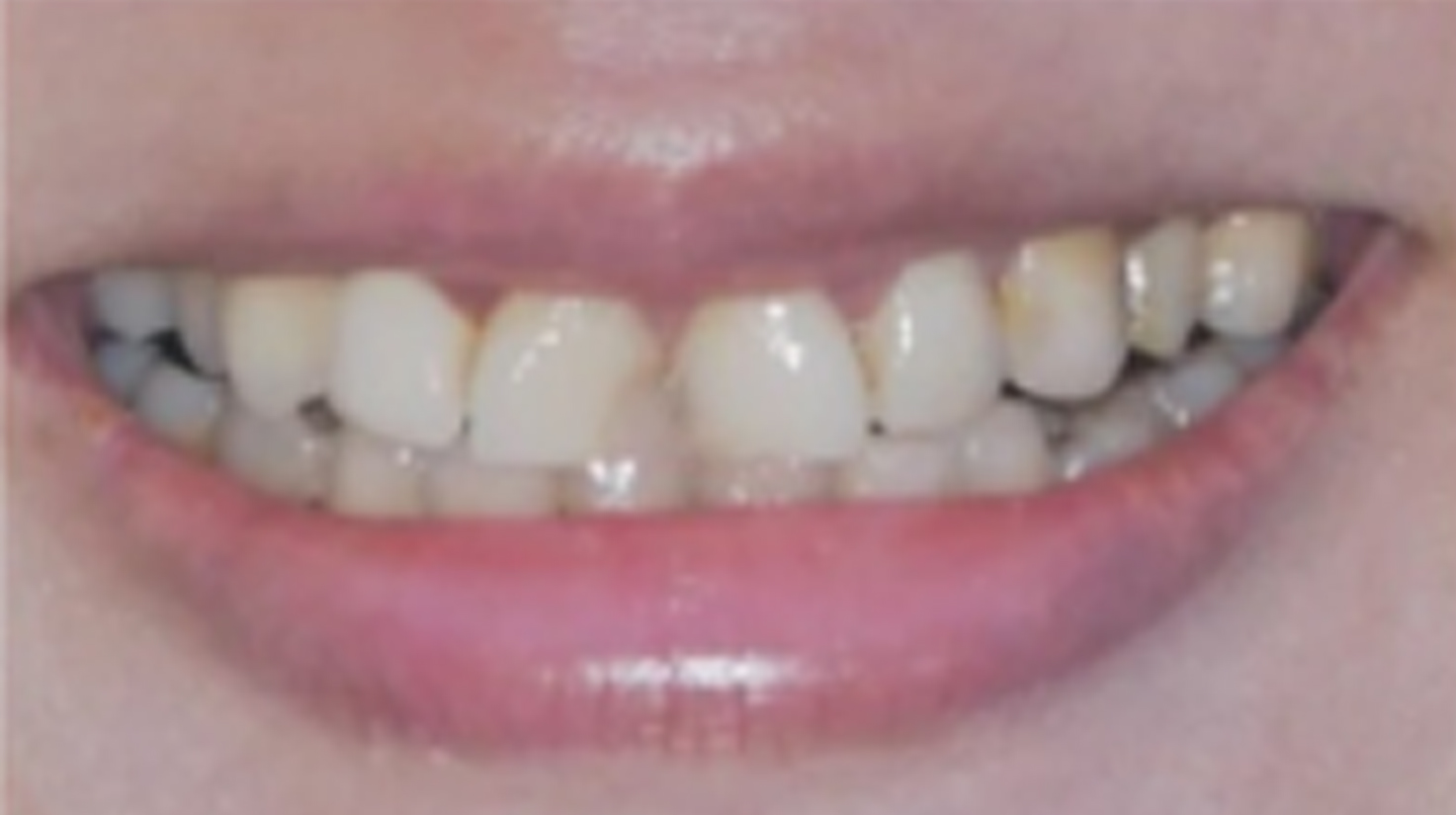 Antes caso 2